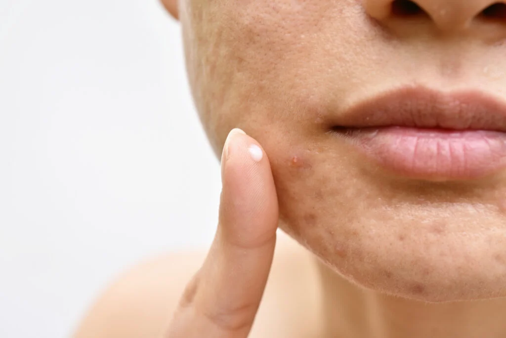 Câteva remedii naturale prin care poți scăpa de acnee. Un medic dermatolog le explică pas cu pas