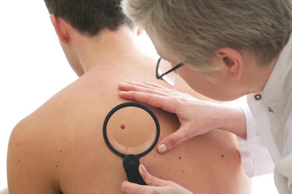 Cum puteți depista dacă vă confruntați cu cancer de piele. Care sunt semnalele de alarmă