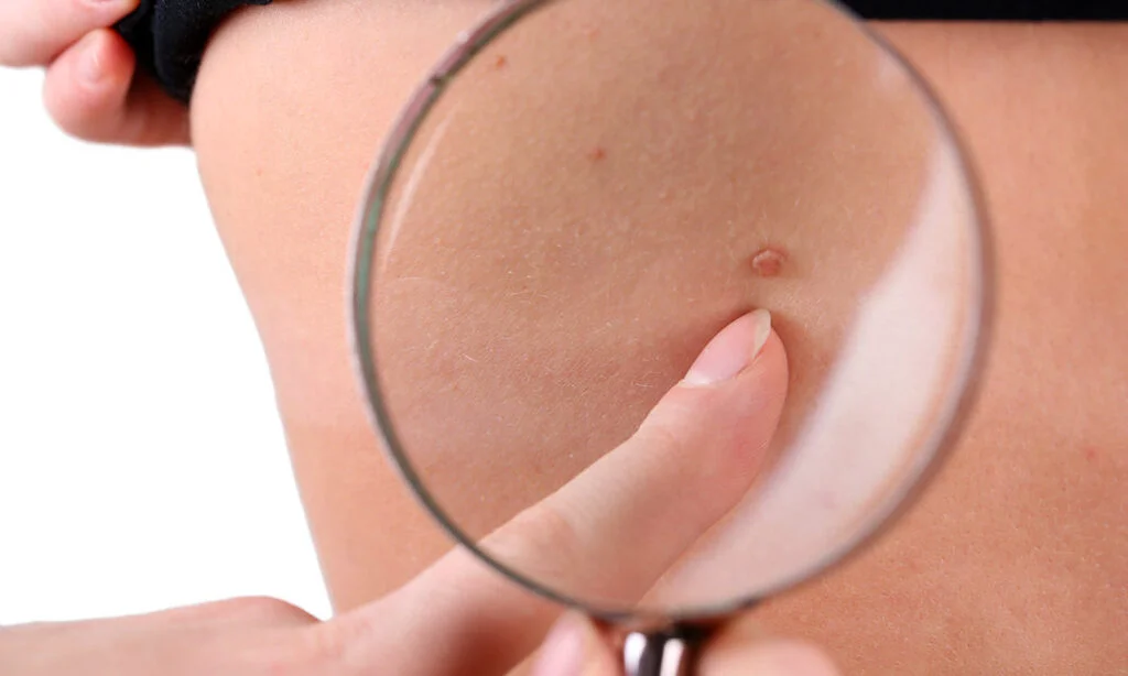 Care este unul dintre simptomele importante ale cancerului de piele