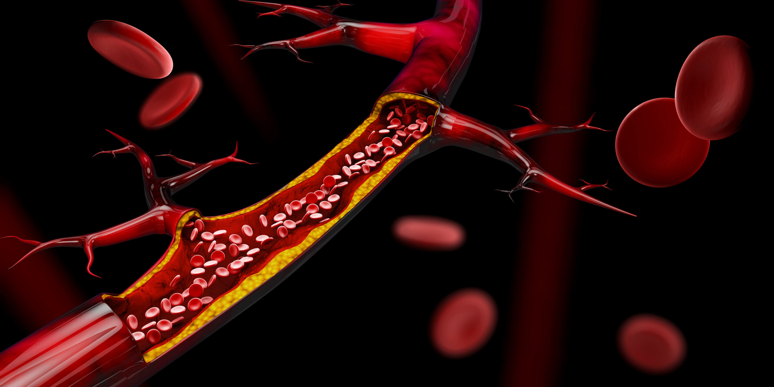 ilustrare 3d de vas de sânge blocat - artera cu acumularea de colesterol realist