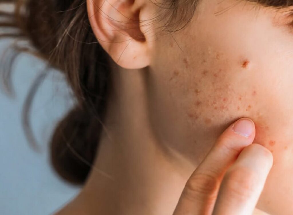 Copilul tău adolescent suferă de acnee? Ajută-l să scape cu ajutorul programului gratuit ”Dă cancel acneei”