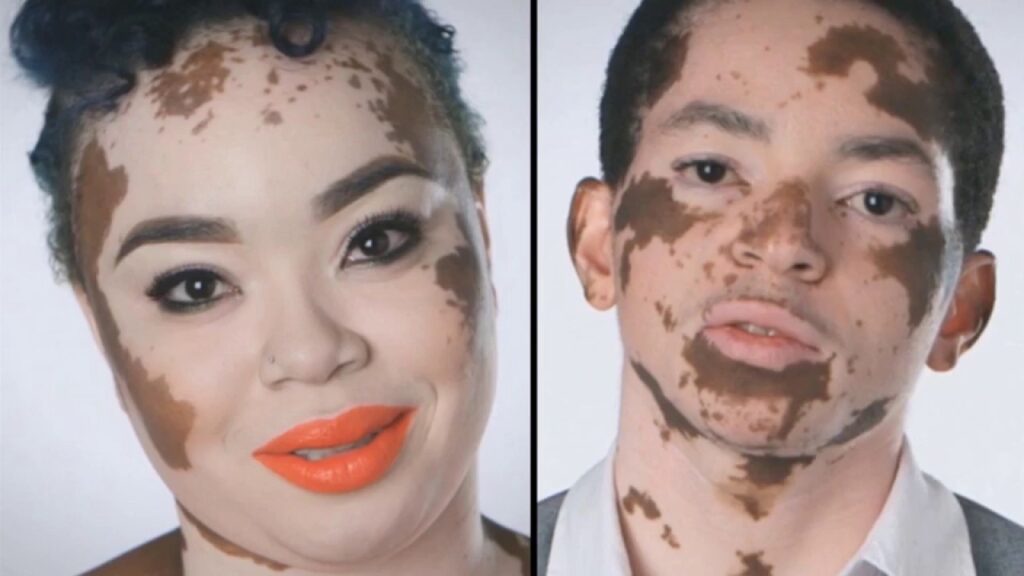 Noi descoperiri despre Vitiligo. Când apar primele simptome și care este tratamentul