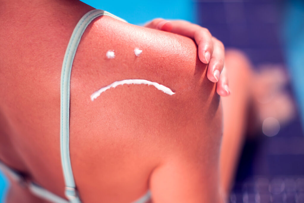 Remedii simple pentru arsurile solare. Cum să îți îngrijești pielea după ce ai stat prea mult la plajă
