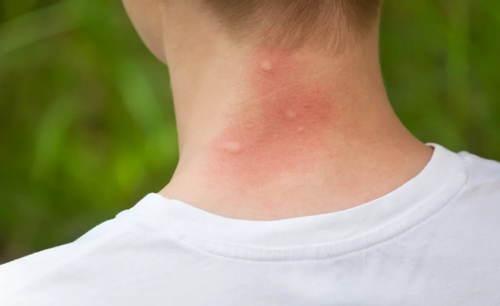 Remedii naturale pentru a diminua și calma disconfortul cauzat de înțepăturile de țânțar