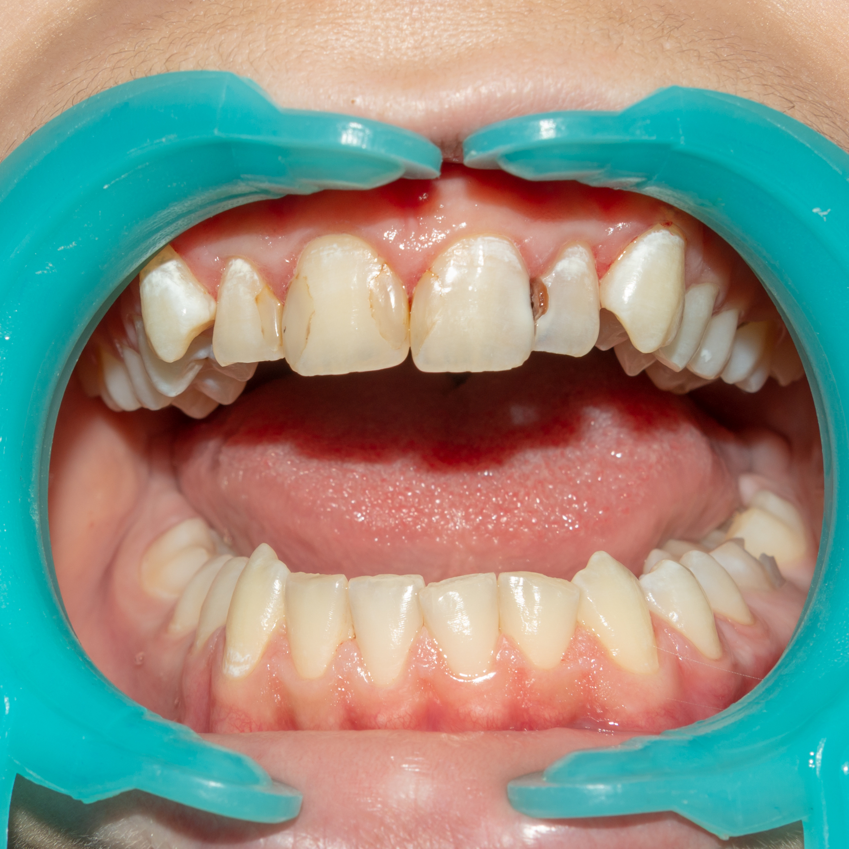 Regenerarea dinților. Deja se lucrează la un medicament special