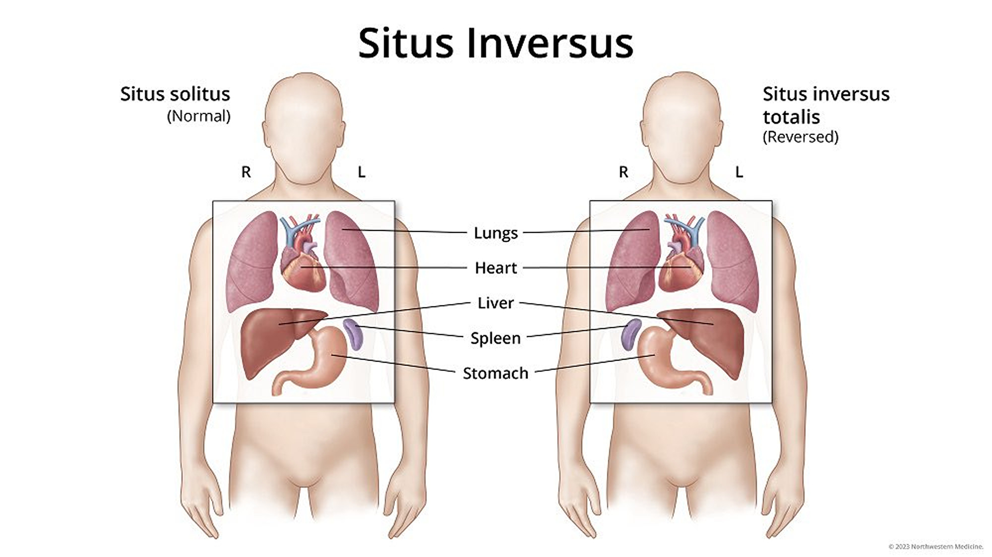 situs inversus