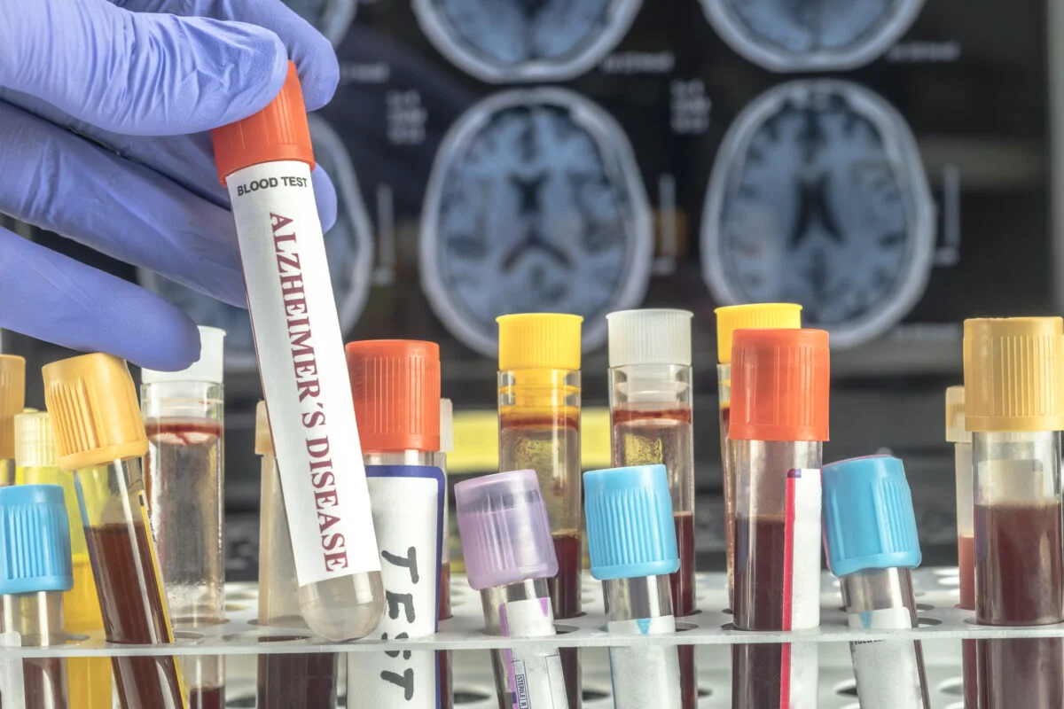 Un pas înainte în lupta cu Alzheimer. Test de sânge aprobat pentru diagnostic precoce