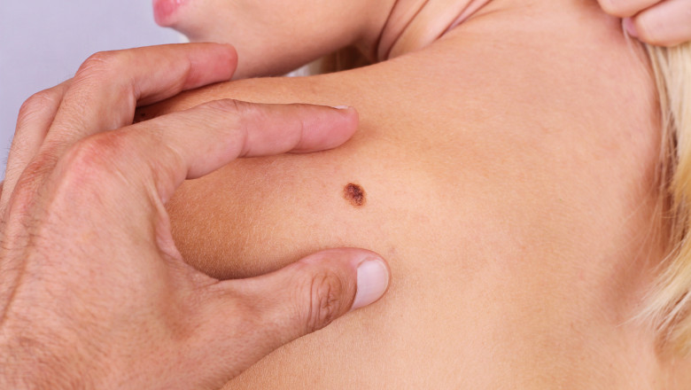 Peste 10.000 de moldoveni suferă de cancer de piele, inclusiv copii
