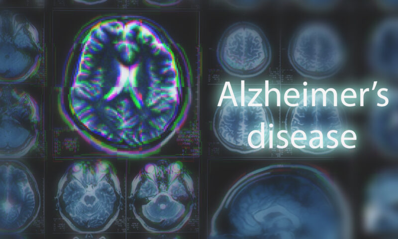 Moleculă naturală din organism, posibil tratament pentru boala Alzheimer