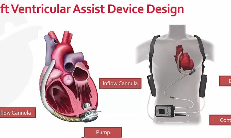 Dispozitiv cardiac care ucide pacienții, folosit în Regatul Unit. E scandal imens