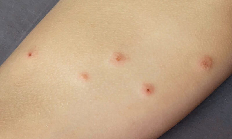 Tânără mușcată de ploșnițe pe CFR. Experiență de coșmar în vagonul-cușetă