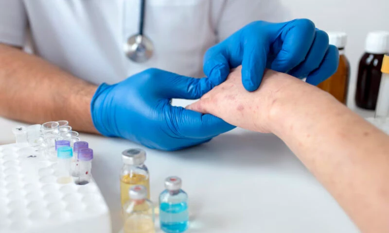 Încă un caz de lepră confirmat în Cluj. Alți trei pacienți, supuși verificărilor medicale