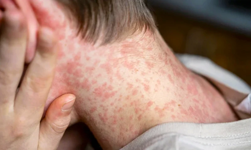 Alertă globală de rujeolă. Panică pe aeroporturile americane. România rămâne epicentrul epidemiei în Europa