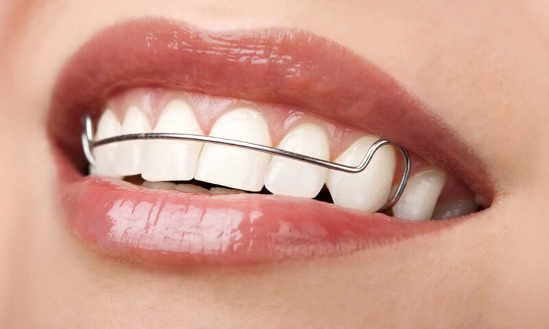 Retainerul dentar: menținerea rezultatelor obținute cu aparatul dentar